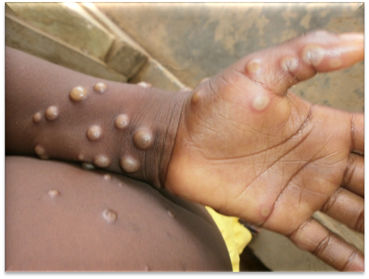 India Mpox Cases